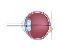 Hyperopia (farsightedness)