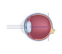 Myopia (nearsightedness)
